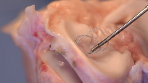 Precision Mr Sutura Menisco All Inside - Image 4