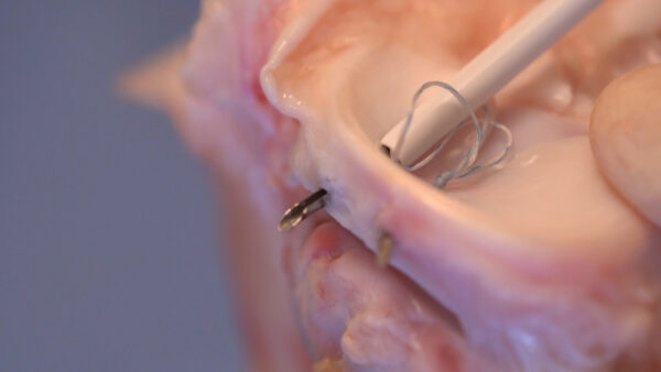 Precision Mr Sutura Menisco All Inside - Image 6