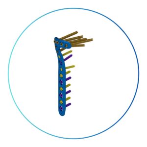 Sistema de Placas GAMA Tibial Proximal